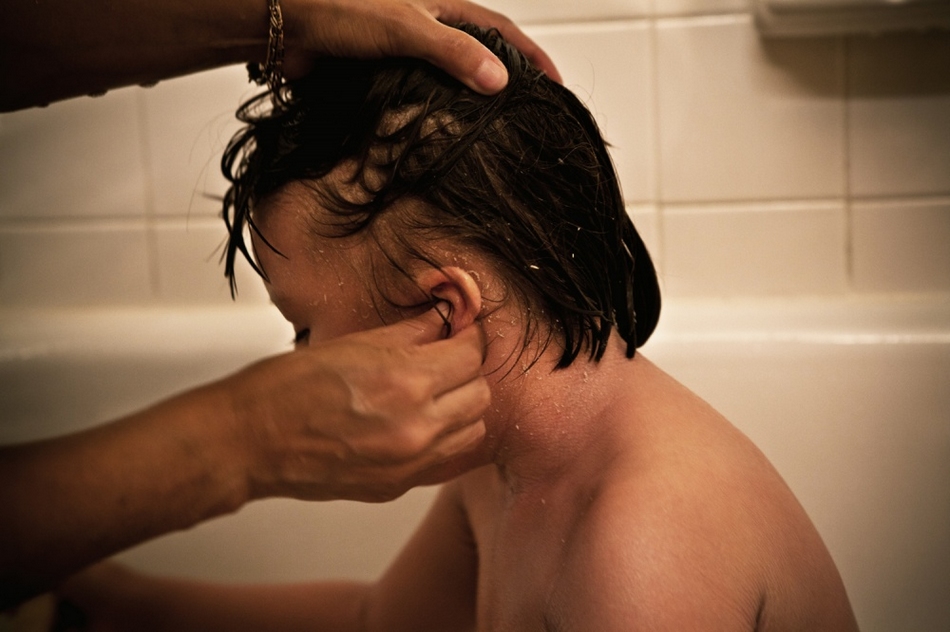 孤兒?。呼~(yú)鱗病女孩的艱難生活【圖】