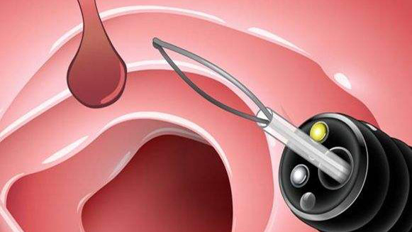 【健康解碼&middot;小貼士】檢查出息肉 需要切除嗎？
